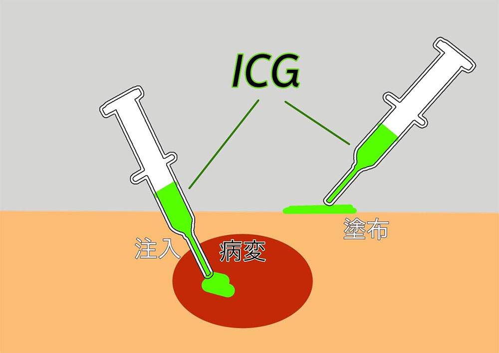 ICGを利用した腫瘍治療
